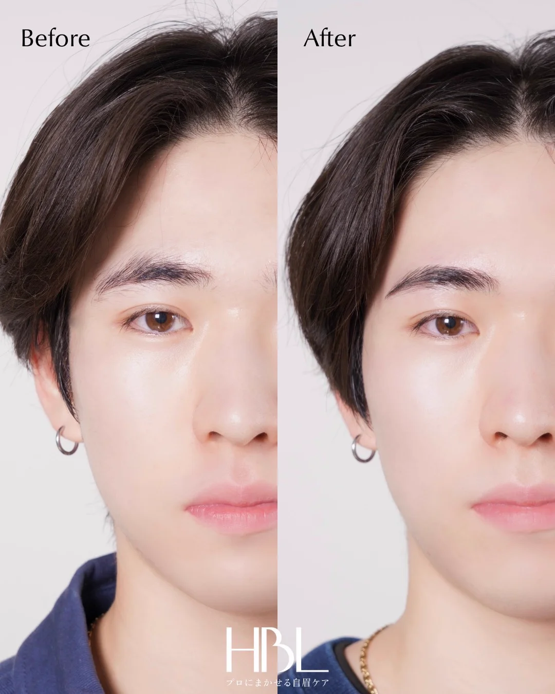 施術例1：Before & After
