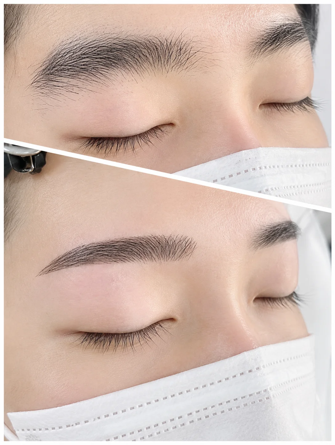 施術例2：Before & After