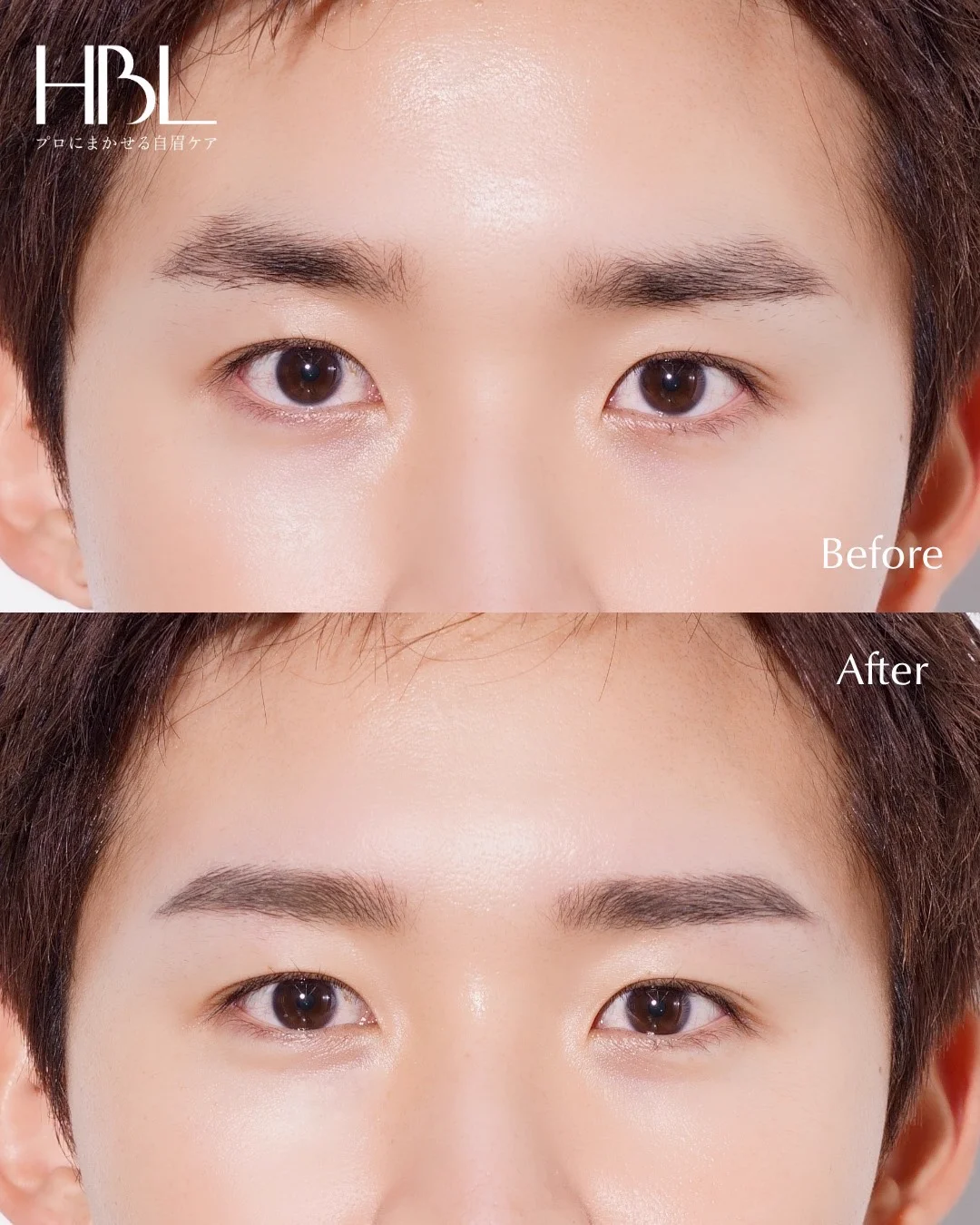 施術例3：Before & After